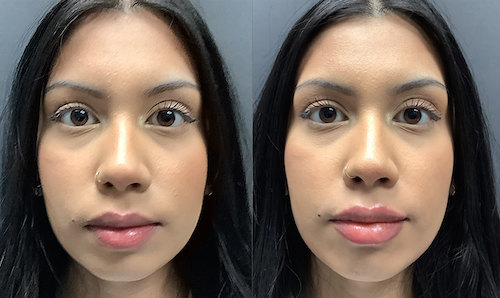 Lip Filler Before After Mississauga Natural Fullness